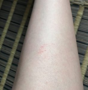 切り傷