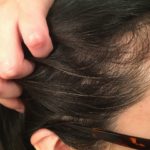 白髪は染めないで直す！ボズレーシャンプー使用１か月後。